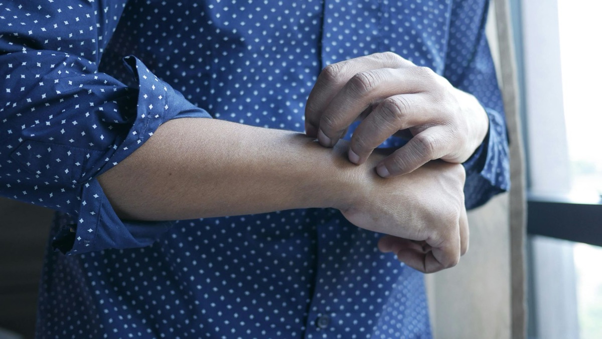 5 Symptoms of Eczema