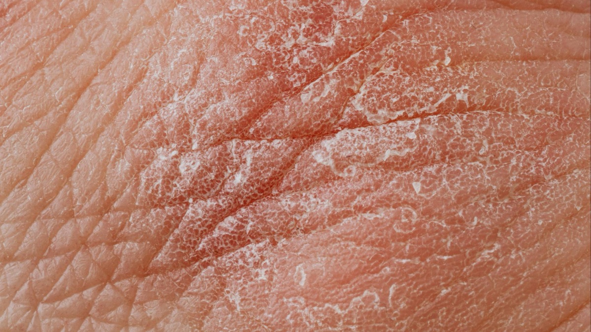 5 Symptoms of Eczema