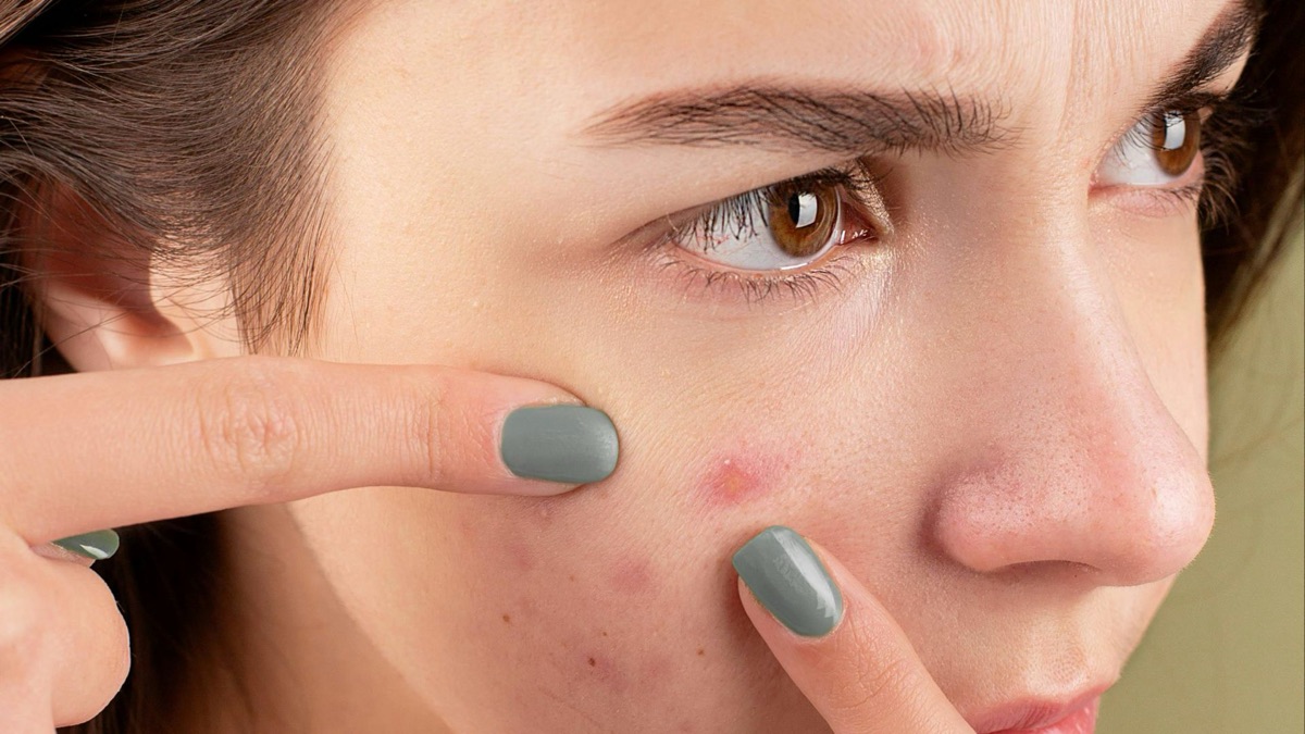 5 Reasons It's Okay To Wear Pimple Patches In Public