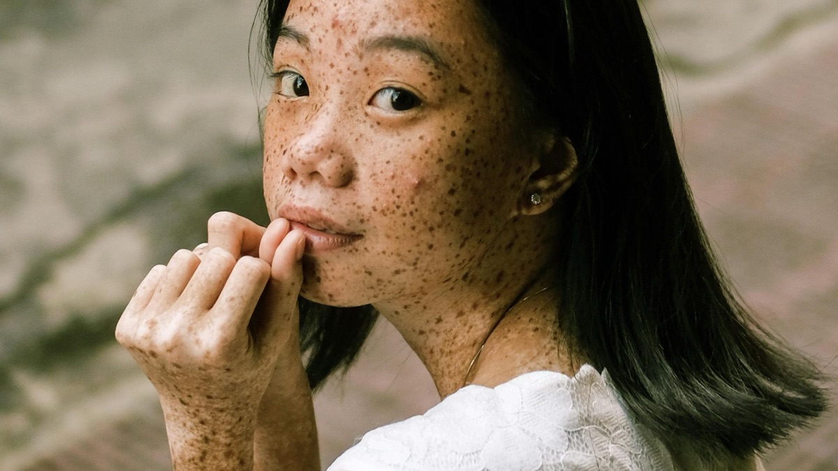 5 Reasons It's Okay To Wear Pimple Patches In Public
